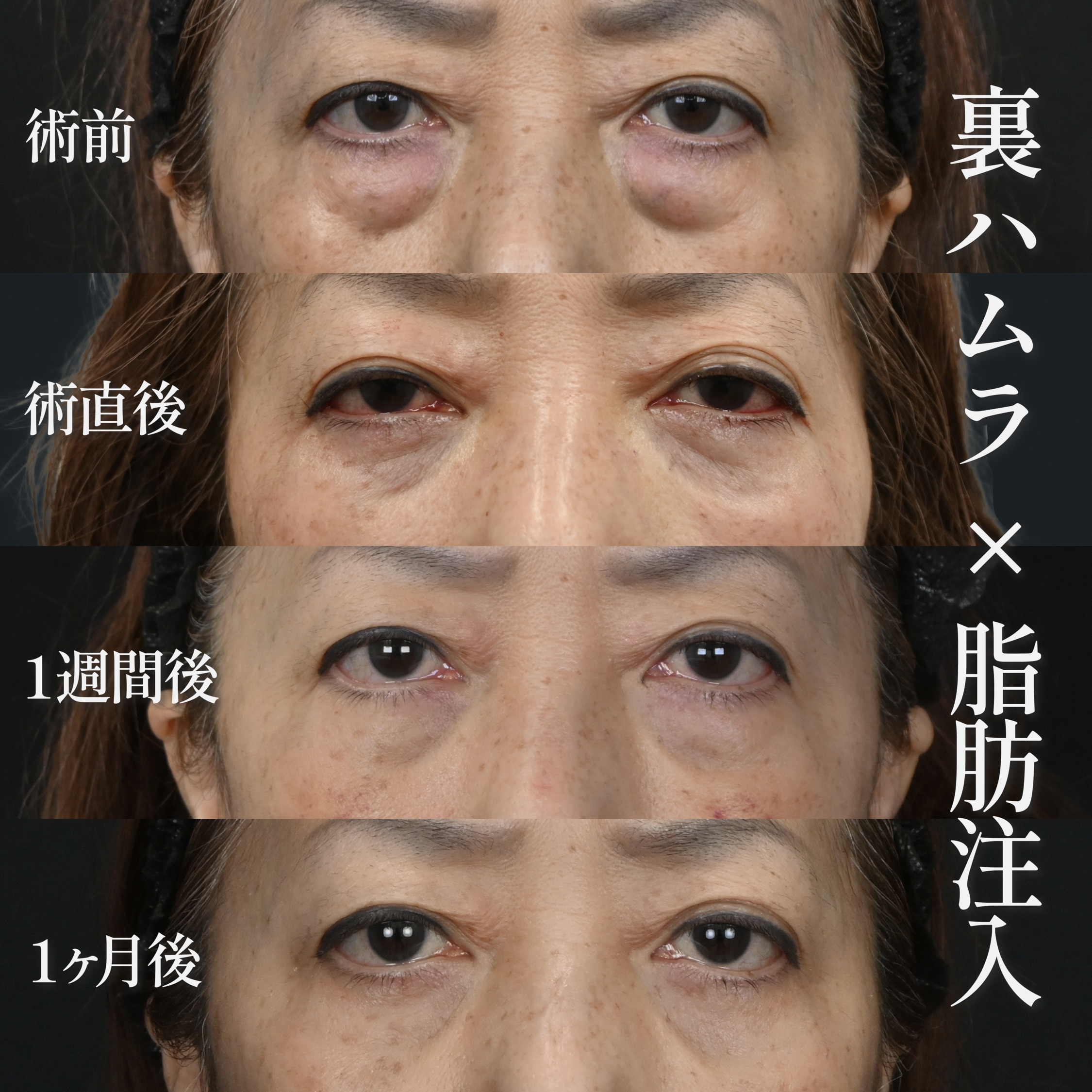 50代:かなり強い膨らみを無くし一気に垢抜ける