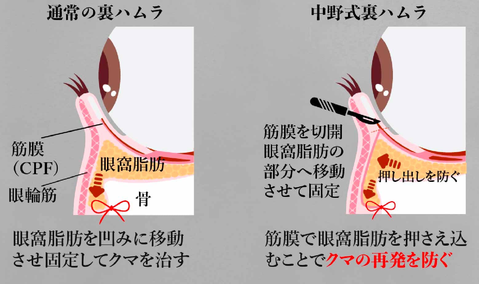 独自に工夫した裏ハムラ法