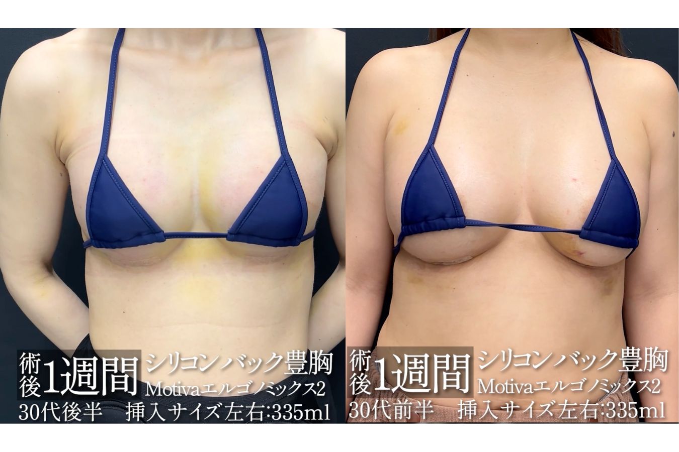 シリコンバッグ豊胸のダウンタイム