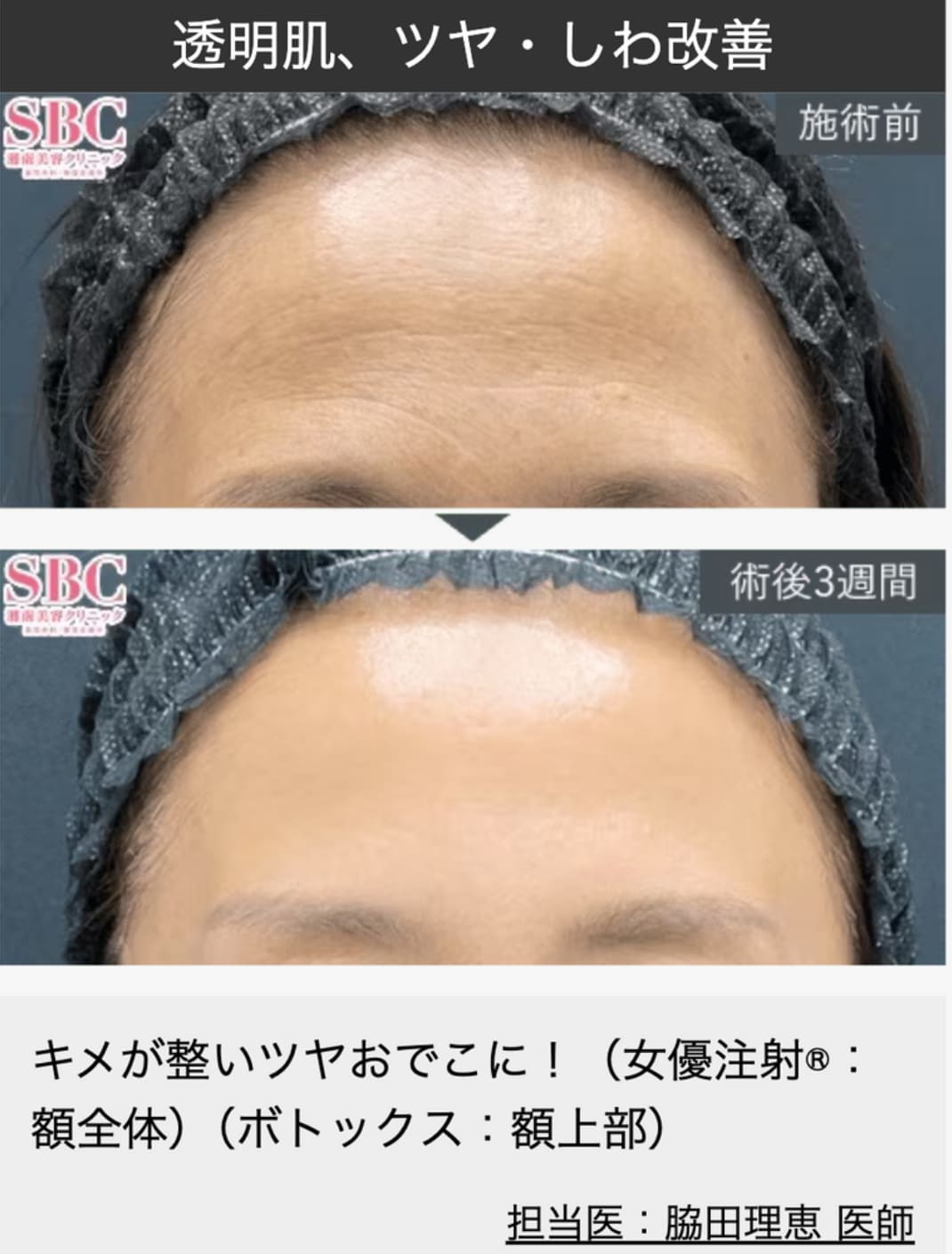 まとめ|しわ・透明肌対策に女優注射®を