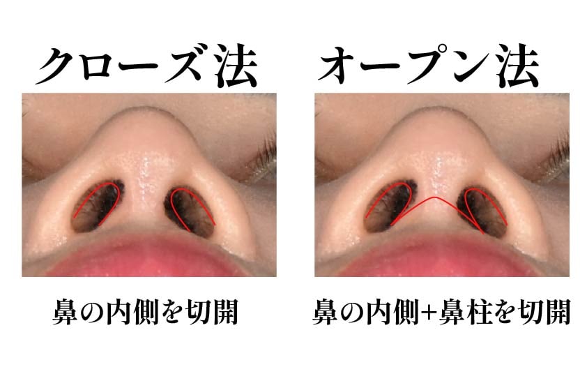 傷跡や感染を極力抑える