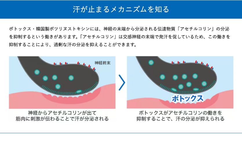 脇ボトックス注射
