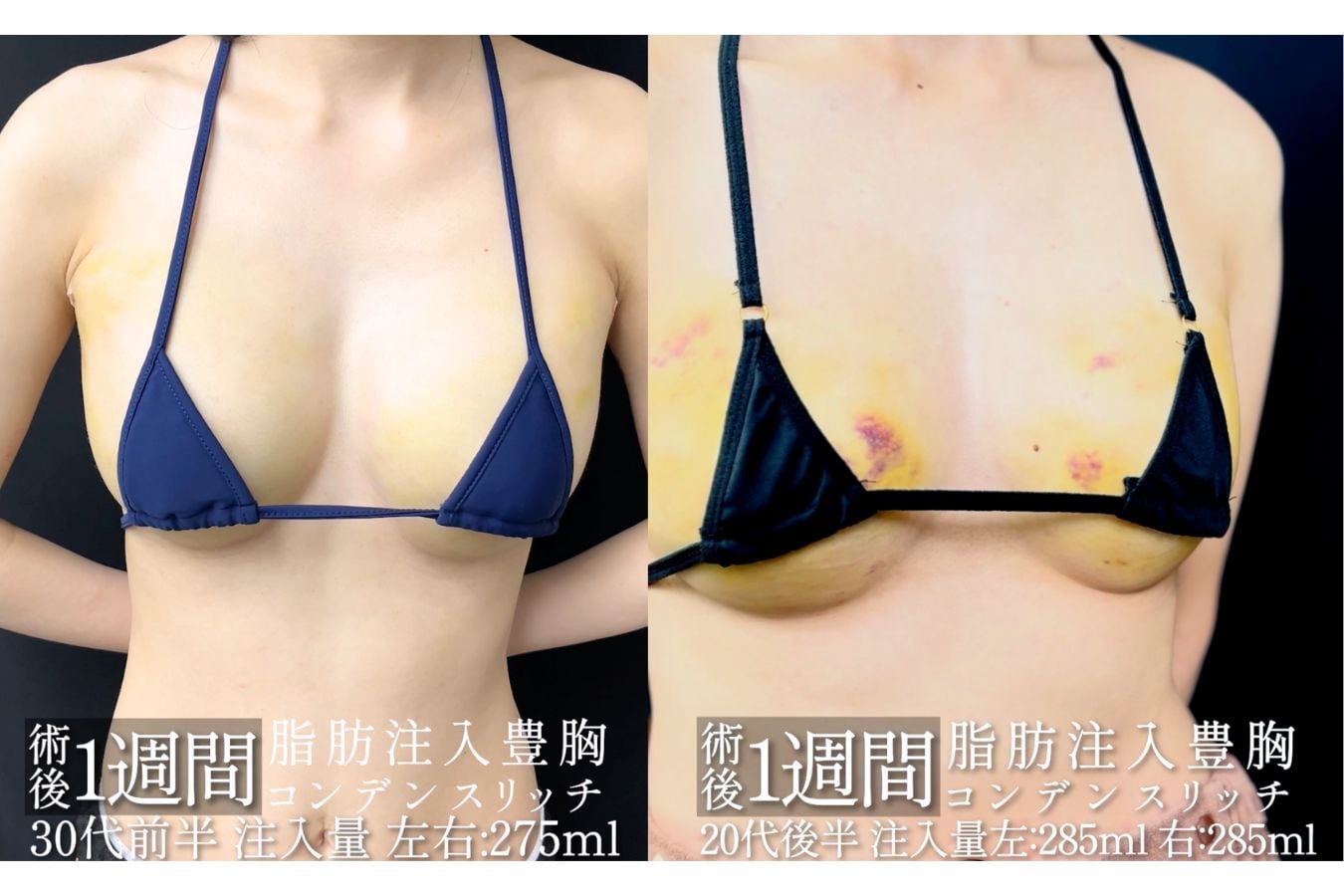 脂肪注入豊胸のダウンタイム