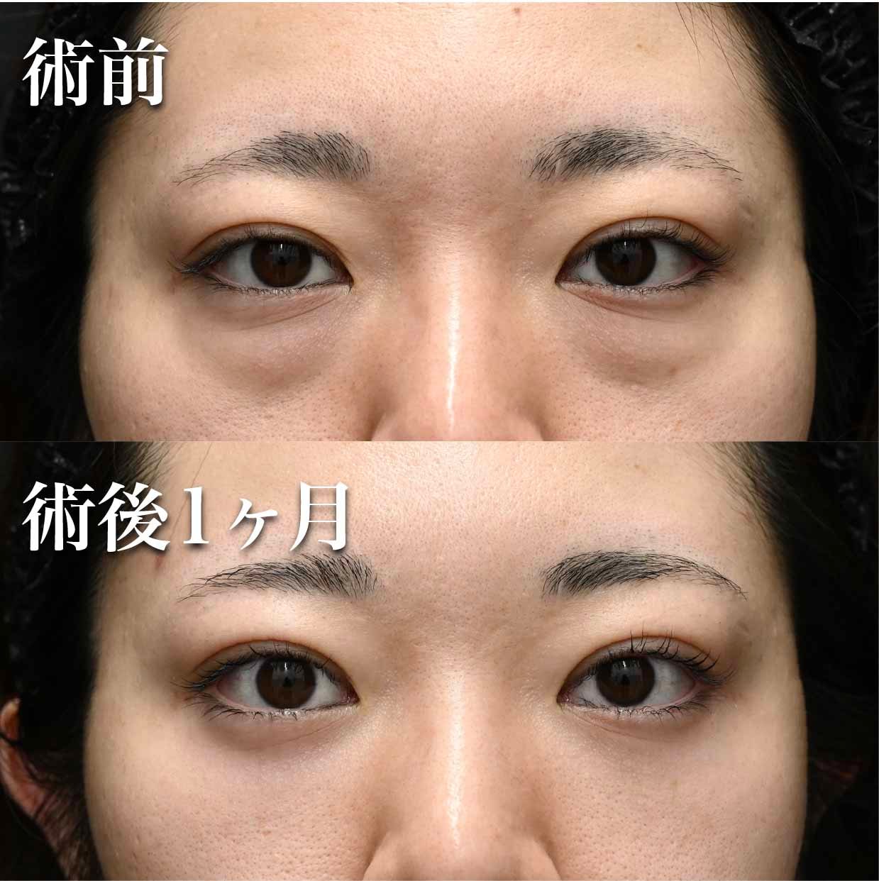 脂肪注入が必要ないケース