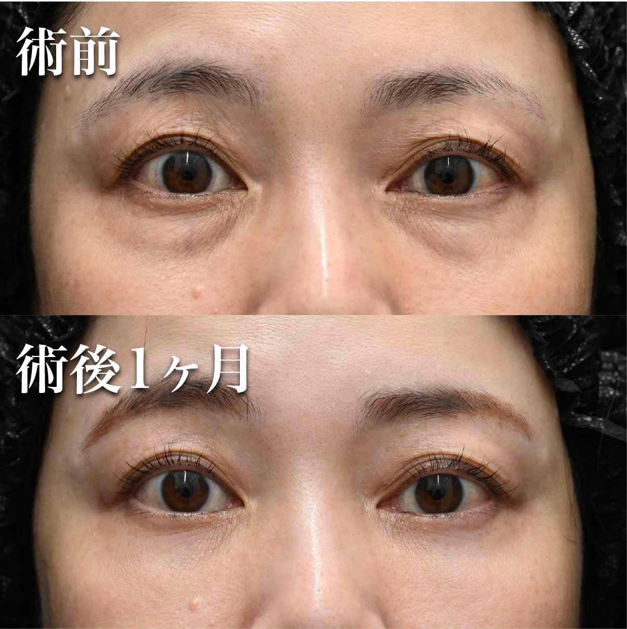 凹み改善の効果