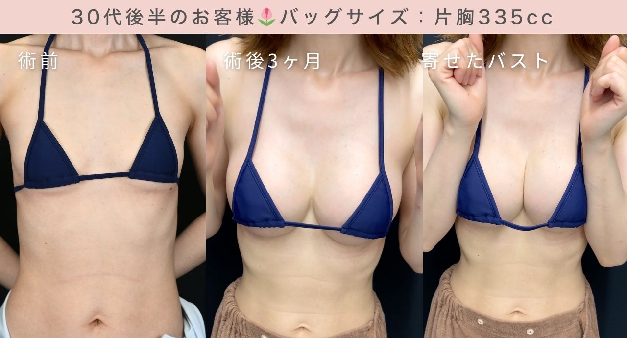 バストサイズに悩んでいたお客様