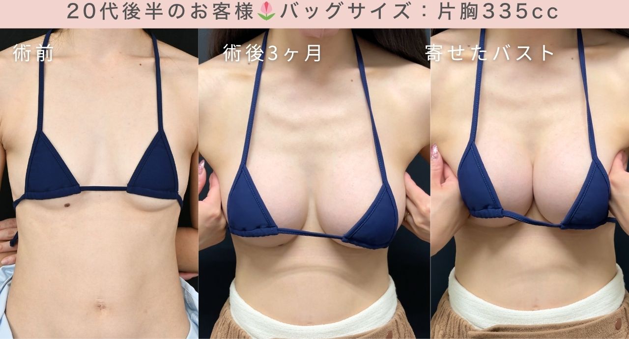 子育てが落ち着いてママ豊胸をしたお客様