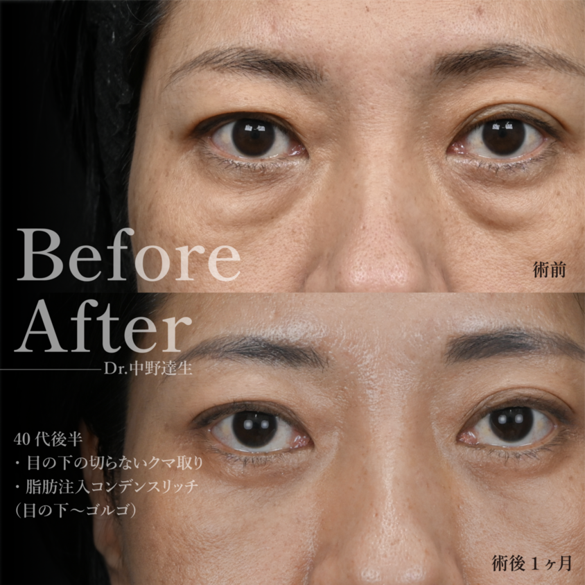 脱脂術 ― 原因である眼窩脂肪を取るシンプルな方法
