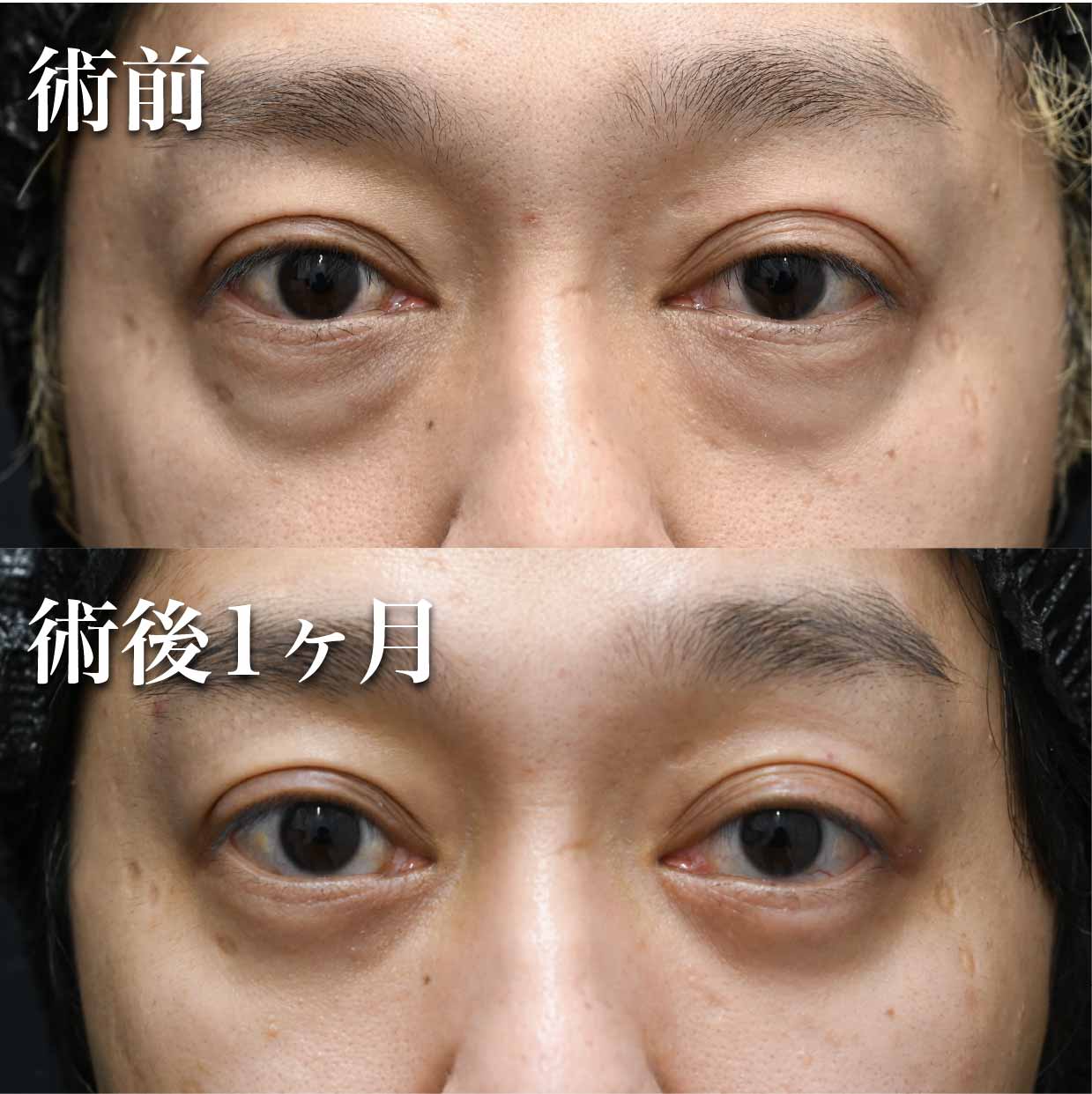 脂肪注入が必要なケース