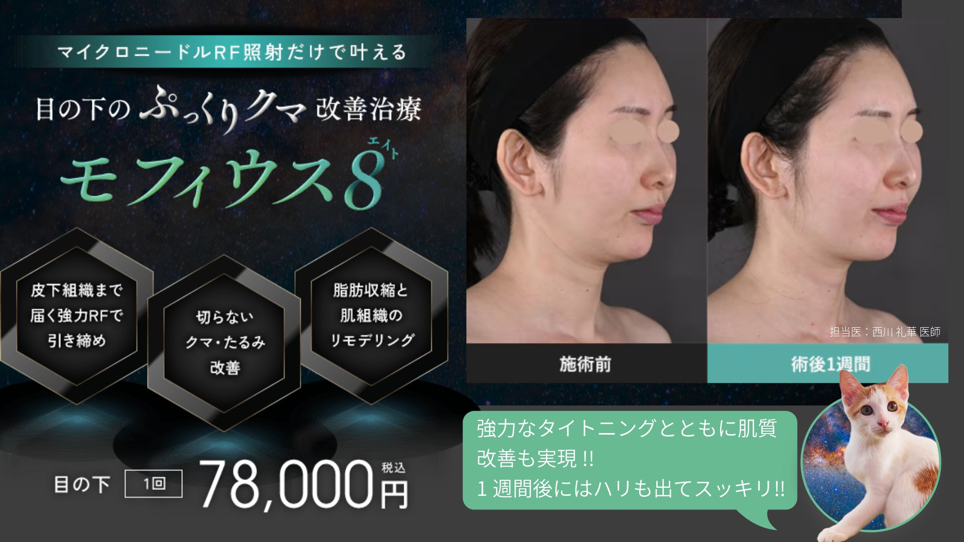 モフィウス8は マイクロニードル＋高周波（RF） を組み合わせた最新美容医療。