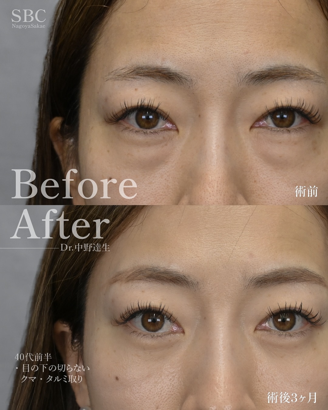 脱脂術-眼窩脂肪を取り除く