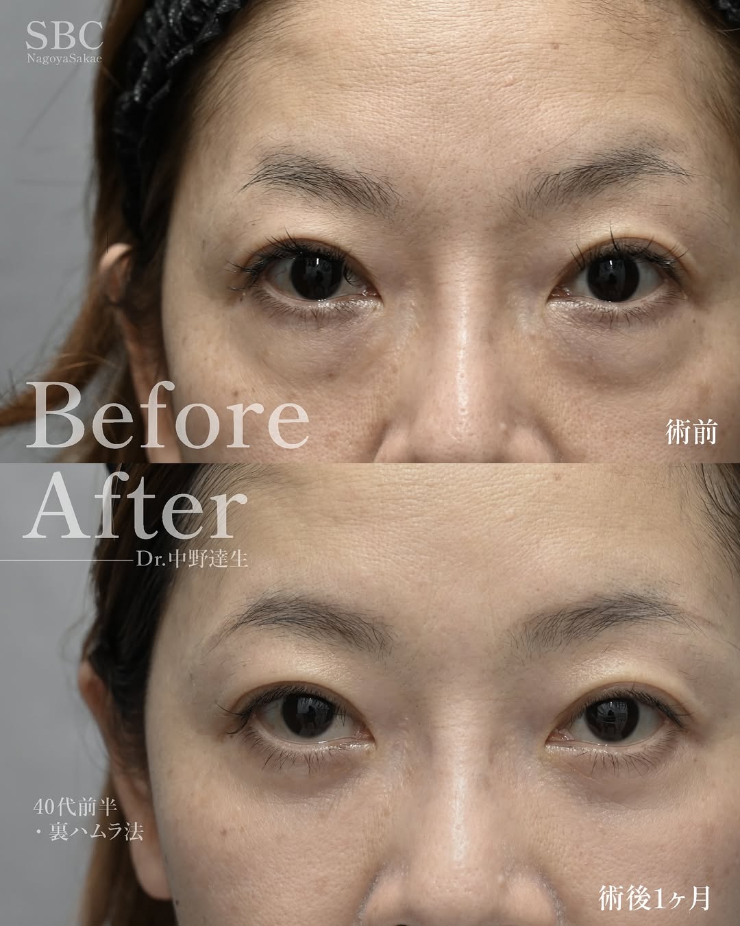 ハムラ法-眼窩脂肪を移動させる方法