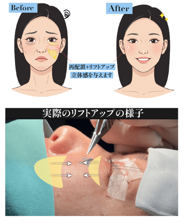 ミッドフェイスリフト