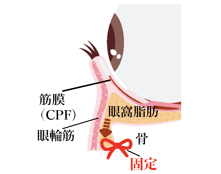 通常の裏ハムラ法