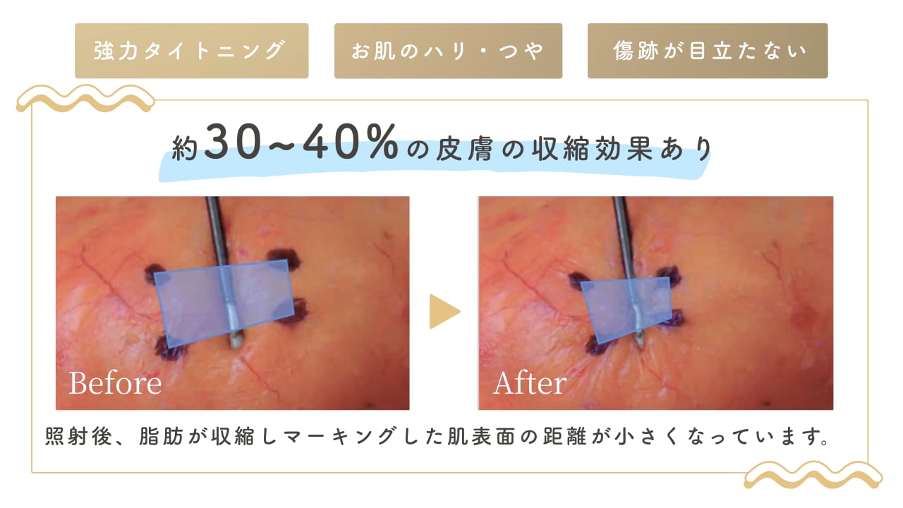 たるみ改善の仕組みと効果