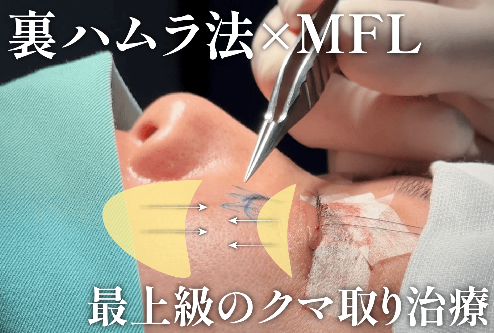 【最高の若返り治療】裏ハムラ×ミッドフェイスリフトで選ぶべき名医とは？