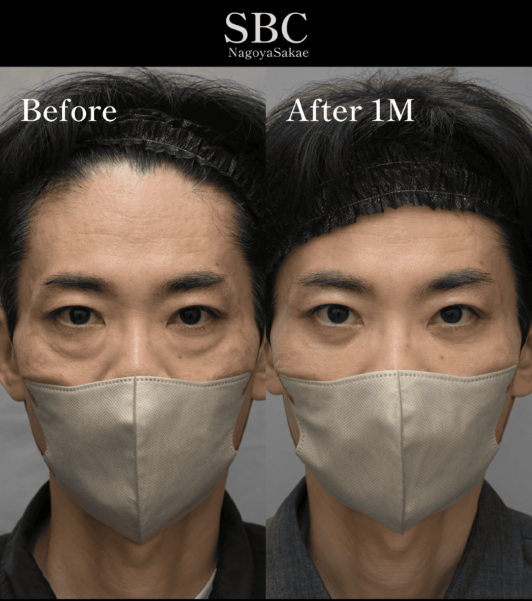裏ハムラと同時に行うミッドフェイスリフトで中顔面全体を若返らせる技術