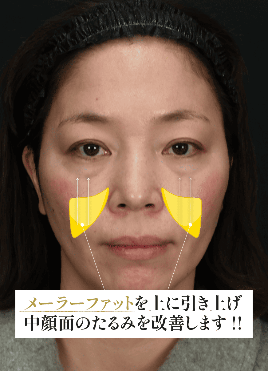 頬の脂肪（メーラファット)をリフトアップする治療です！