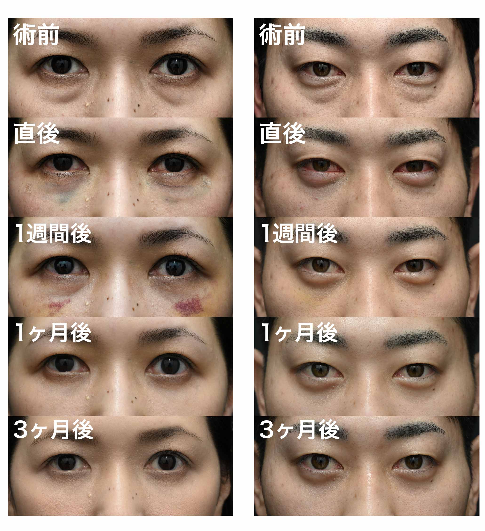 内出血・腫れが目立つ方のダウンタイム紹介