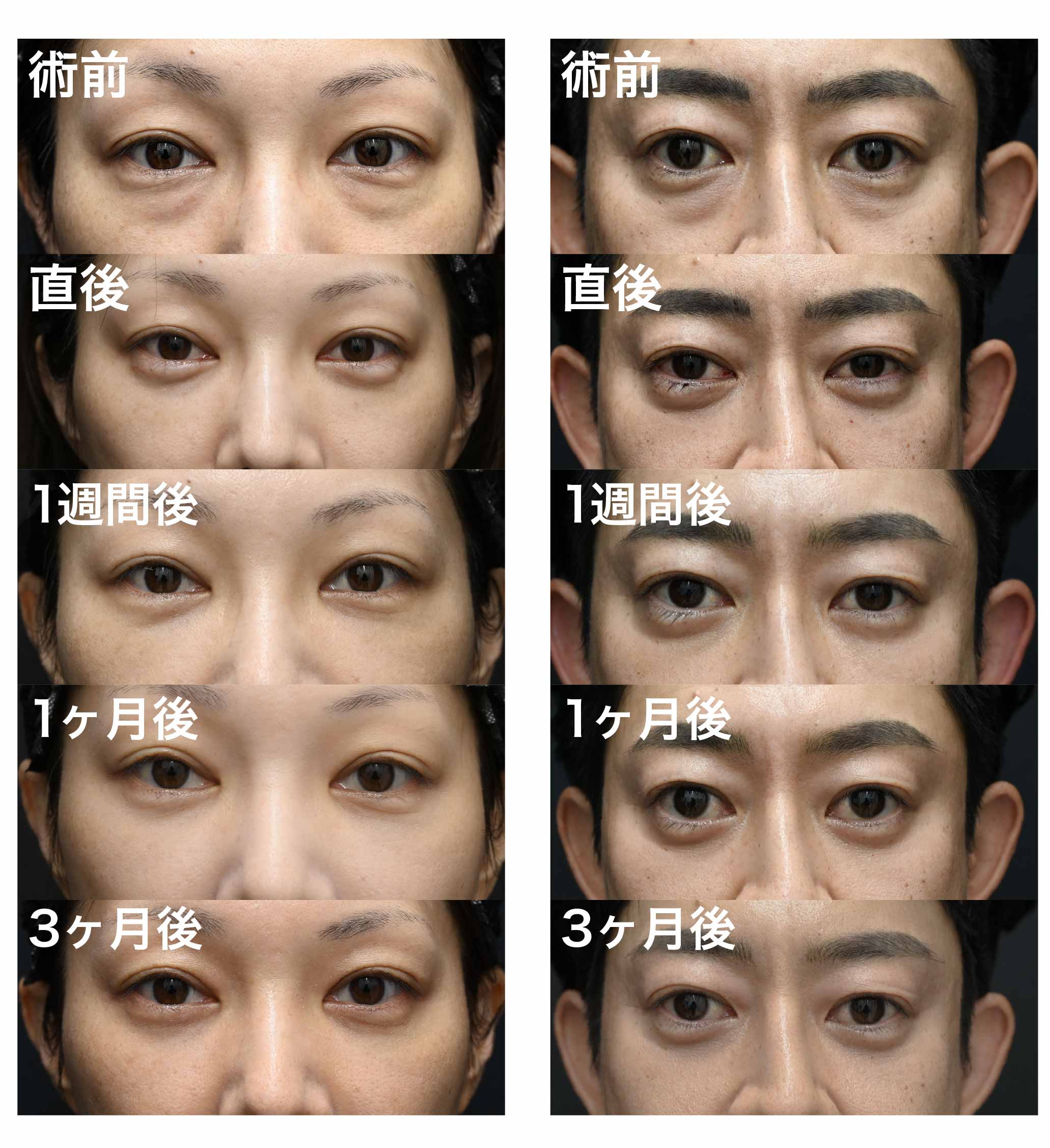 内出血・腫れが目立たない方のダウンタイム紹介