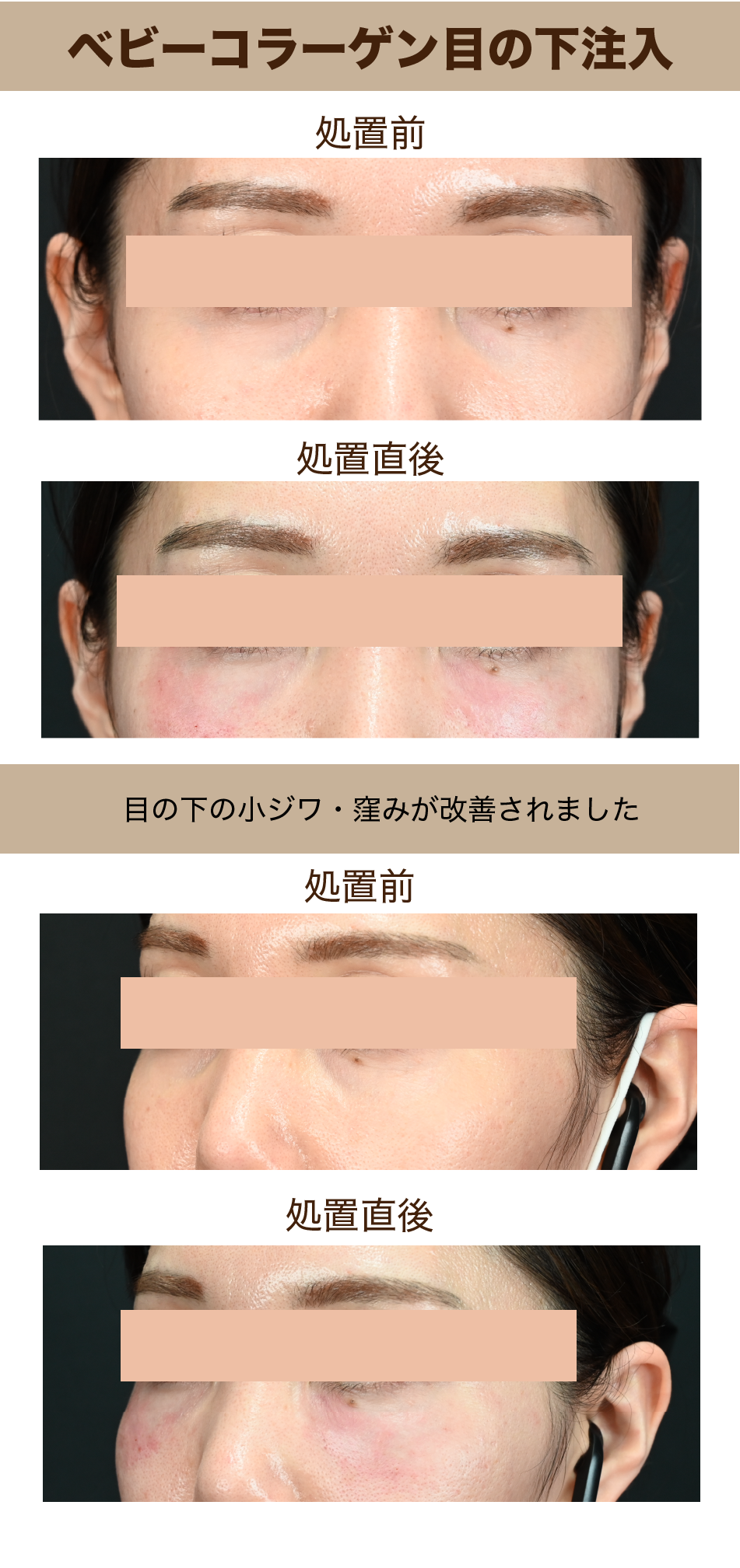 ベビーコラーゲンの特徴と効果