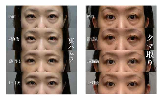 裏ハムラ法・脱脂術を施術したお客様のダウンタイム