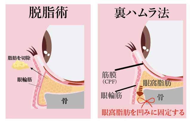 膨らみの原因を根本治療できるクマ取りについて