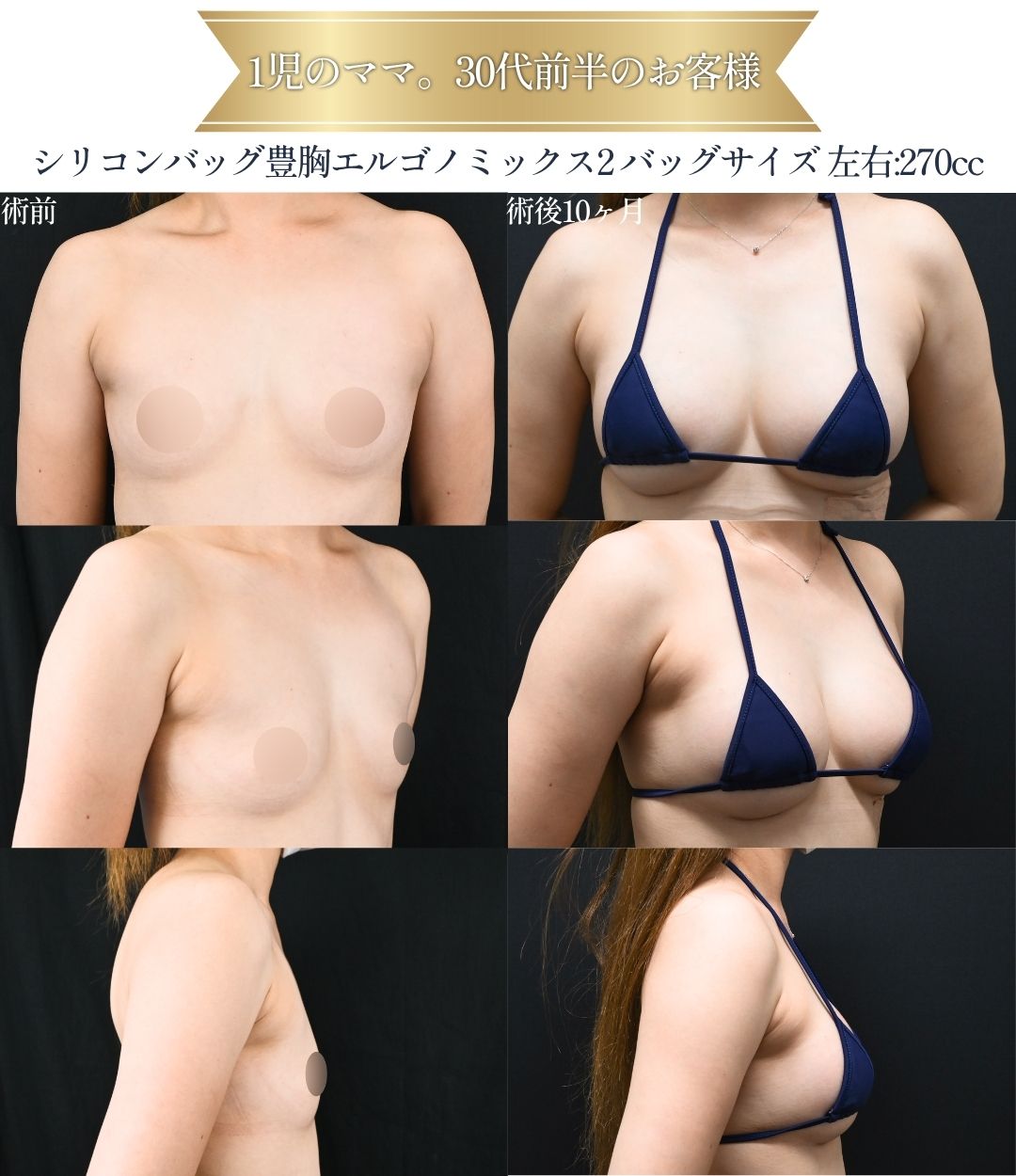 シリコンバッグ豊胸