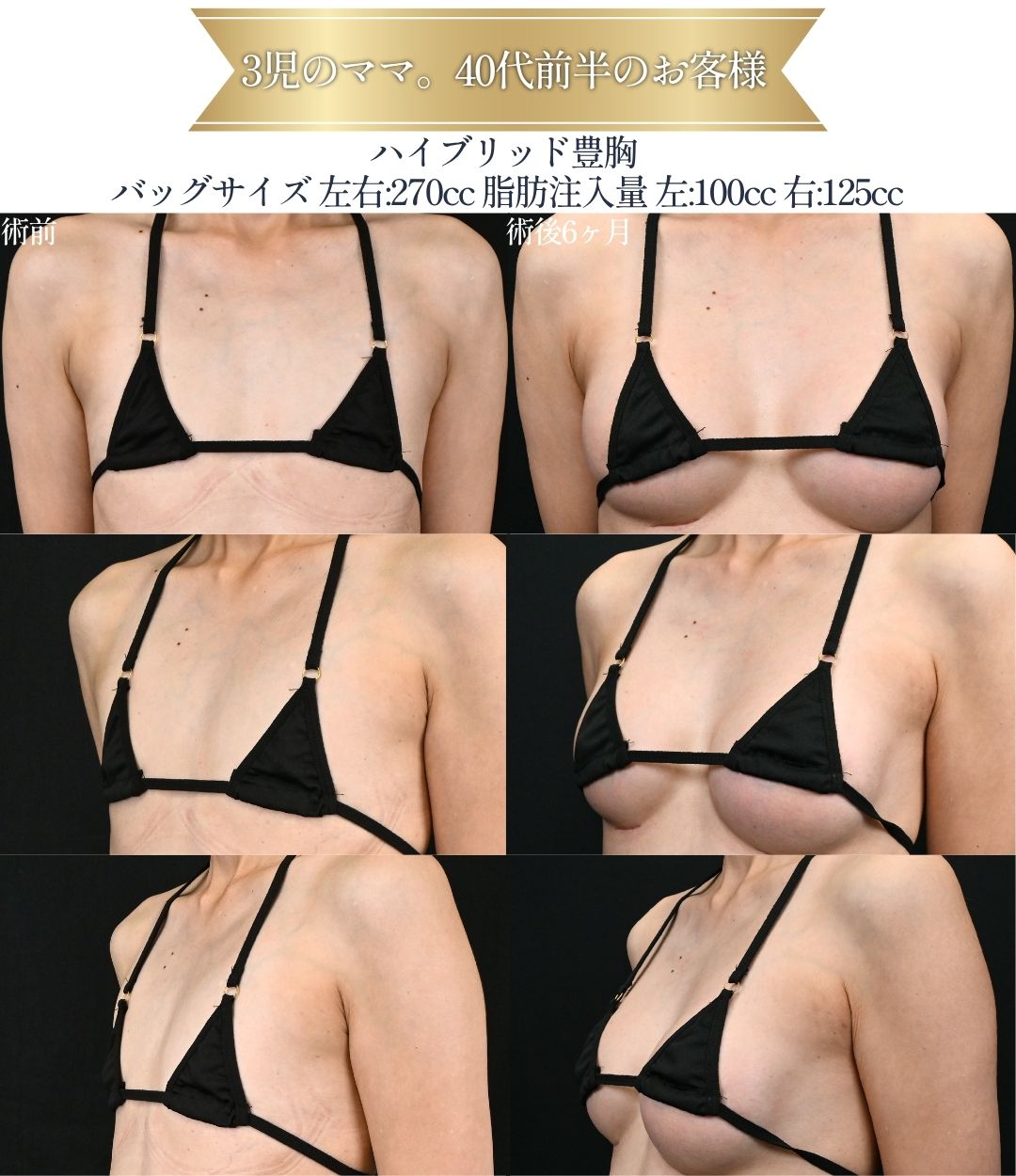 ハイブリッド豊胸