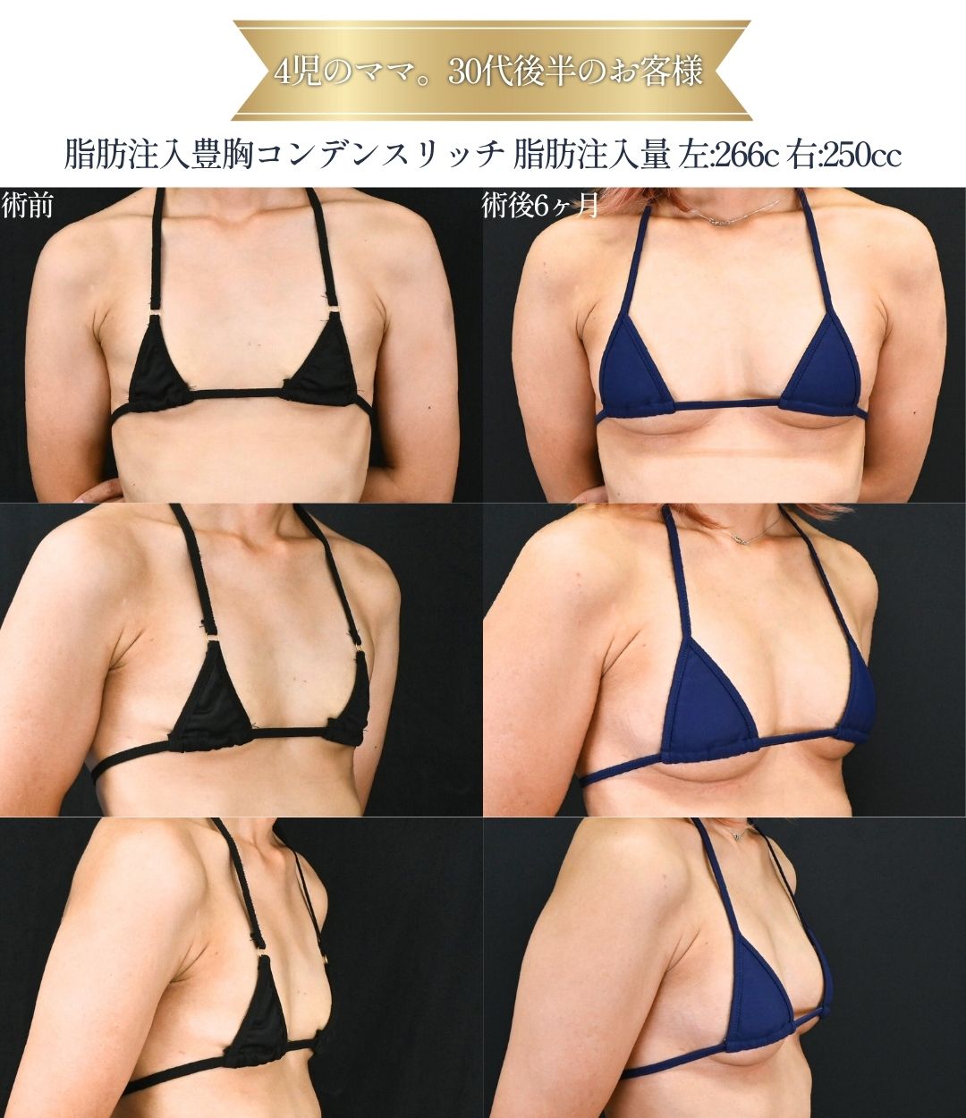 脂肪注入豊胸（自身の脂肪）