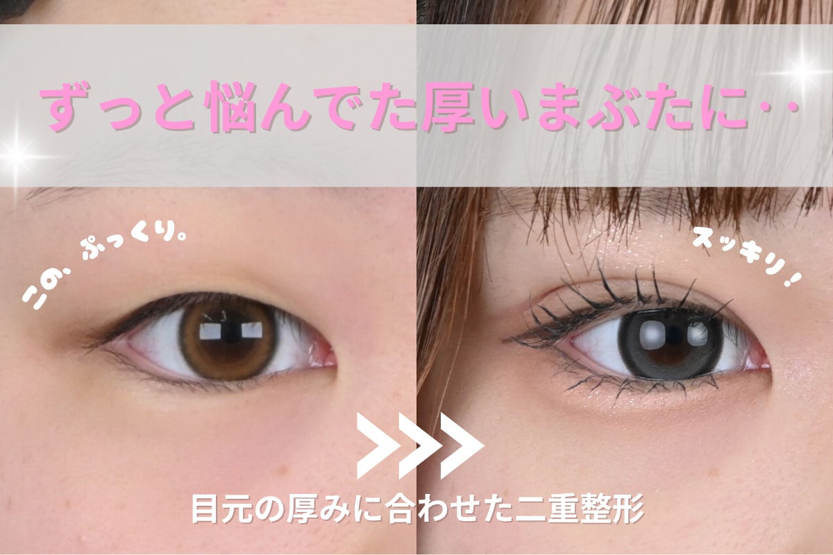 【まぶたが重たい方必見！】埋没法×まぶたの脂肪取りで理想の二重ラインへ