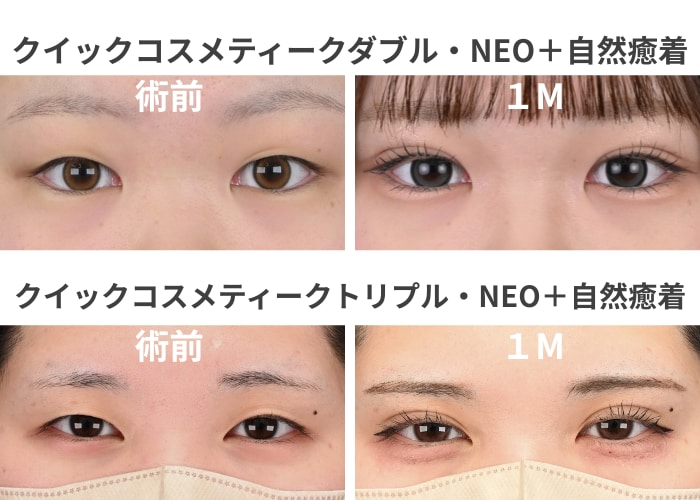 症例（埋没法＋自然癒着セット）