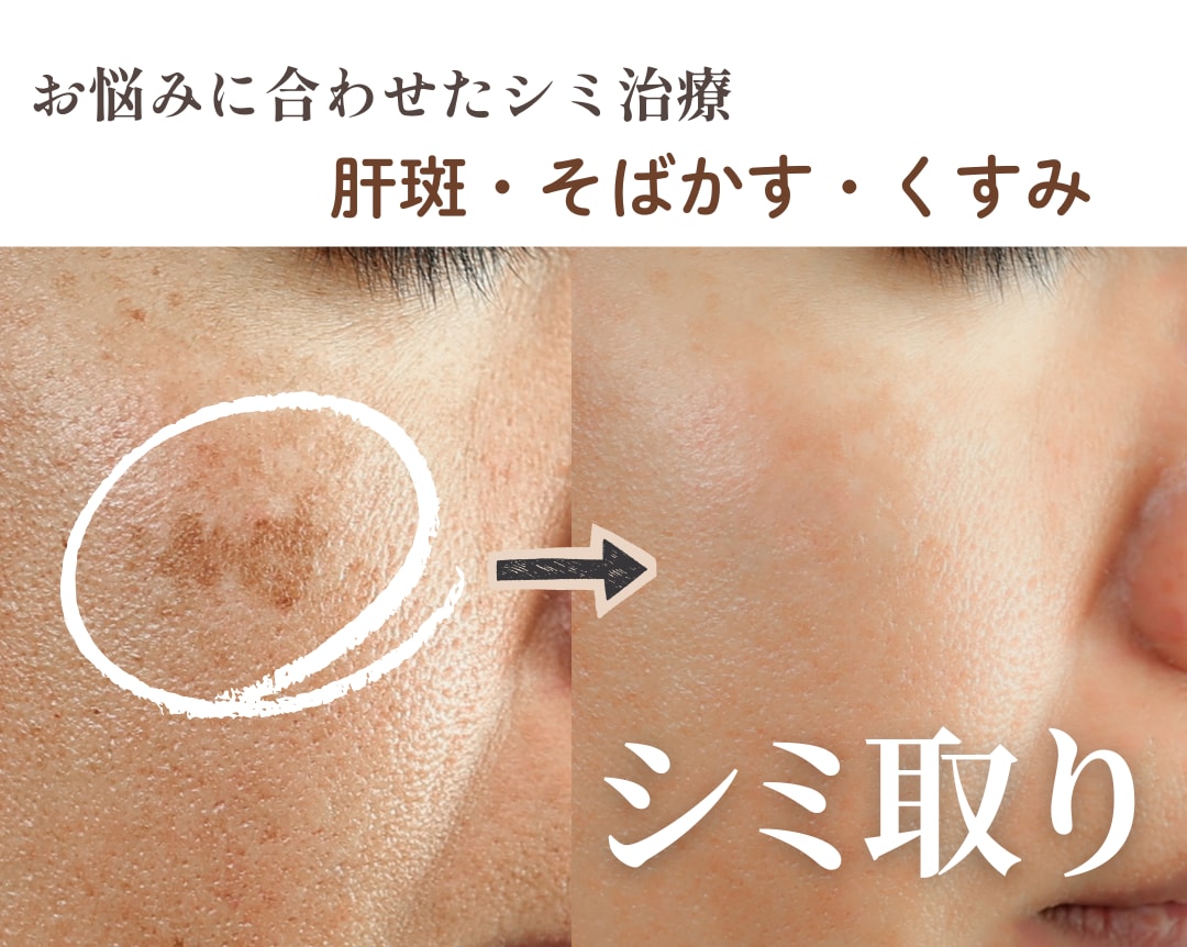 冬のおすすめシミ取り治療｜名古屋で始める“大人の美肌再生”