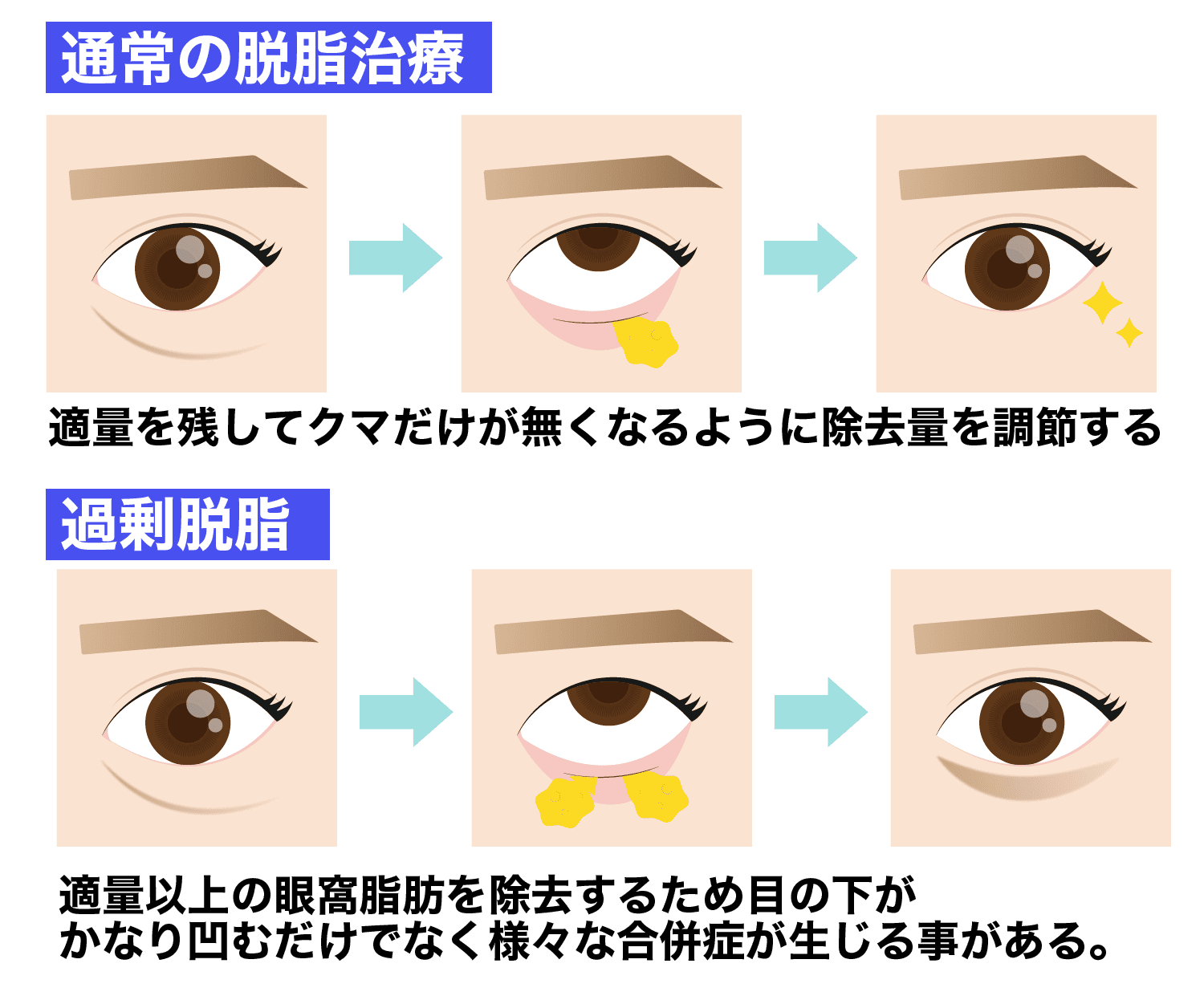 脱脂はあくまでクマ取り治療の１つの選択肢です！