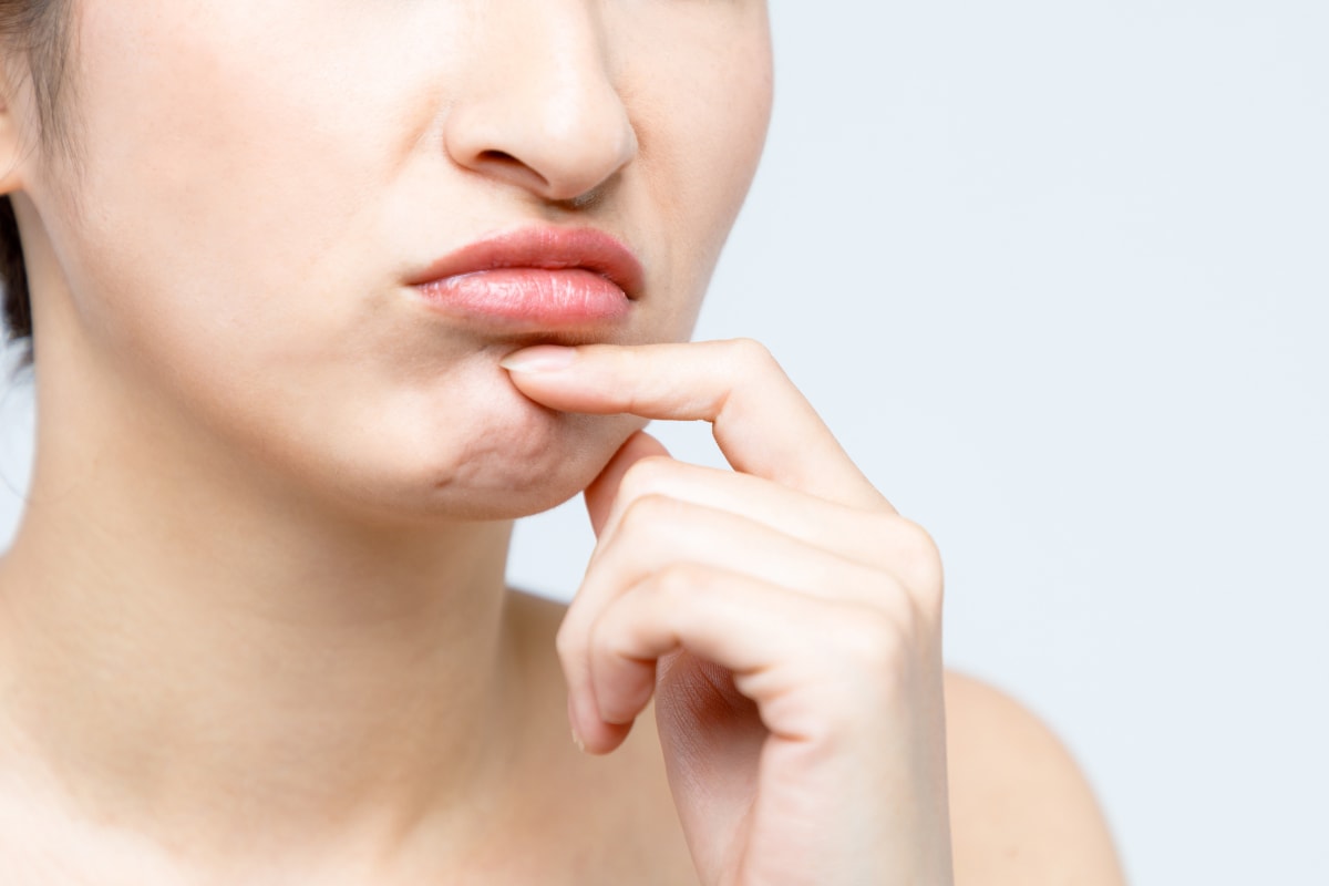 あご（梅干しジワ）口元をなめらかで上品な印象に