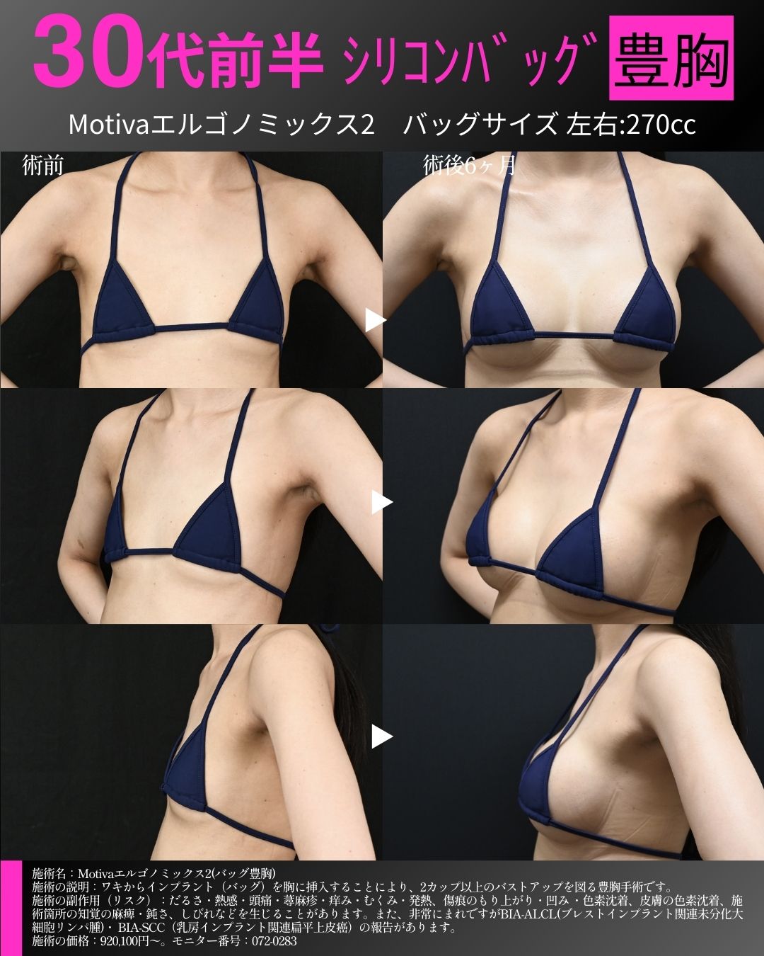 シリコンバッグ豊胸　症例①