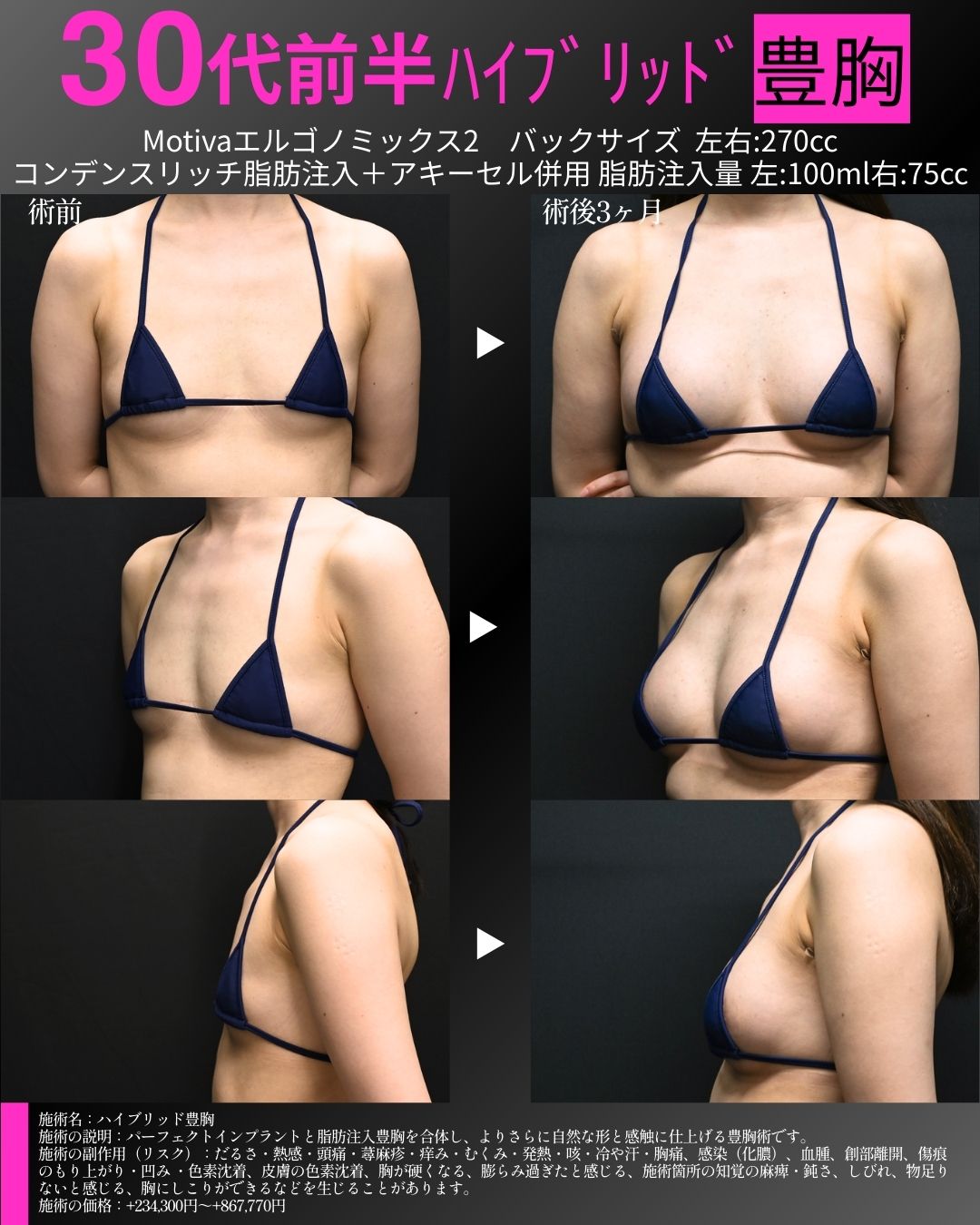 ハイブリッド豊胸