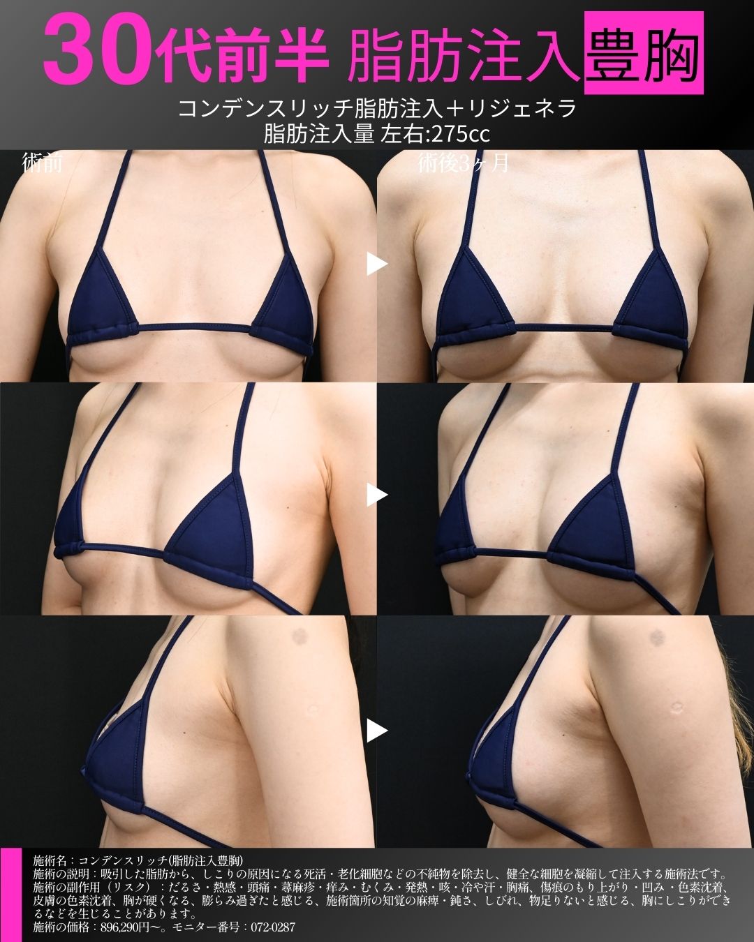 脂肪注入豊胸 症例①