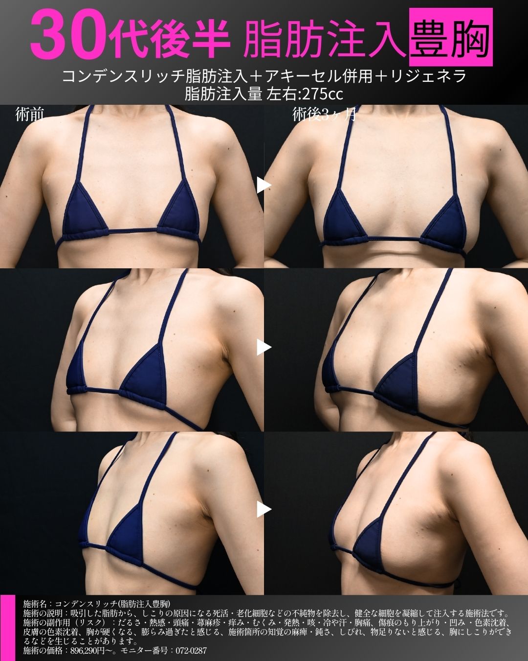 脂肪注入豊胸 症例②