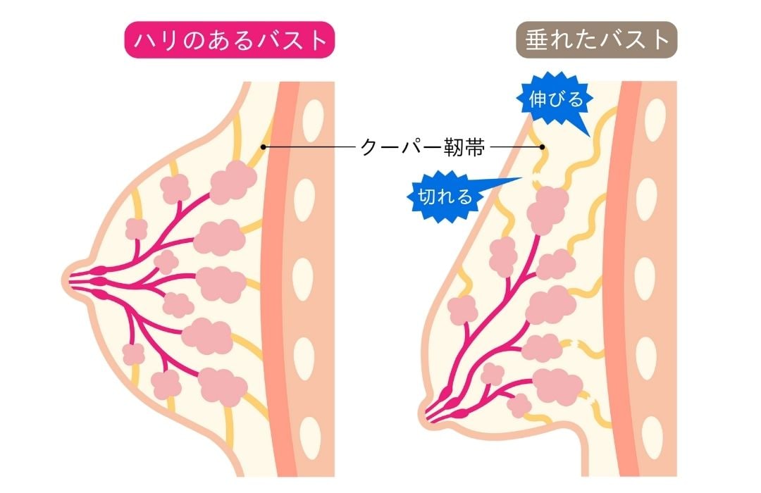 クーパー靭帯の伸び
