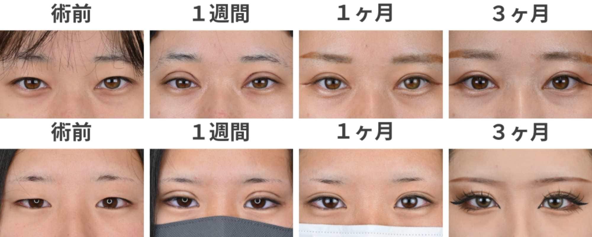 名古屋栄院であなたも理想の目元へ