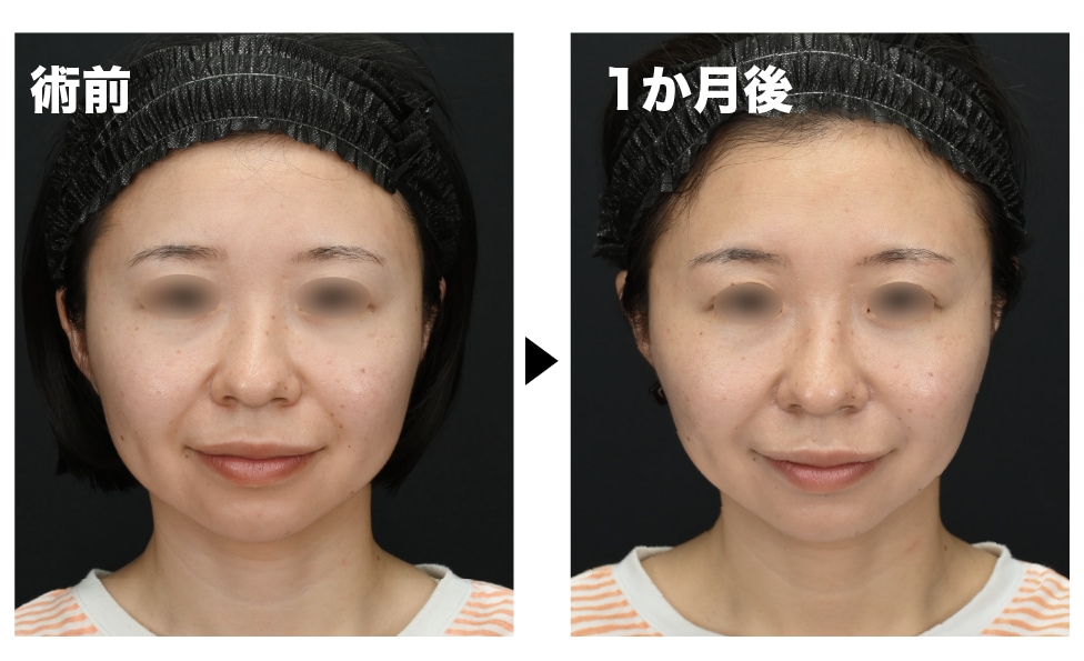 糸リフト × エンブレイス