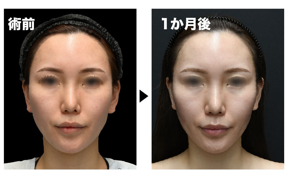 脂肪吸引 × エンブレイス