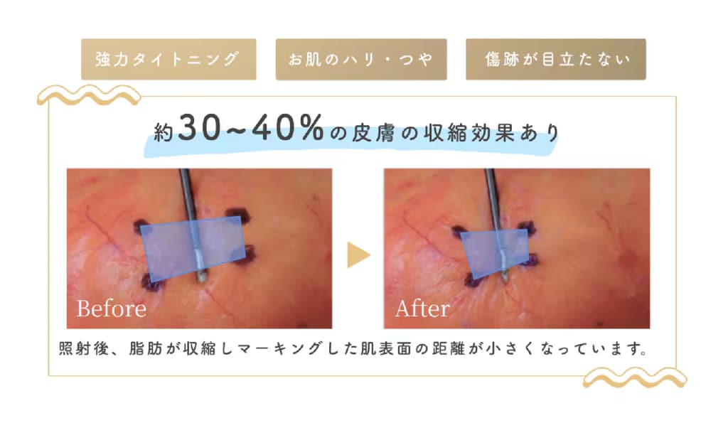 エンブレイスとは