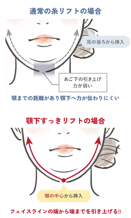 1本の糸で2本分の効果を発揮！顎下のもたつきを解決！