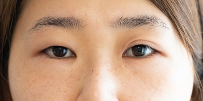 まぶたのむくみ・体重変動