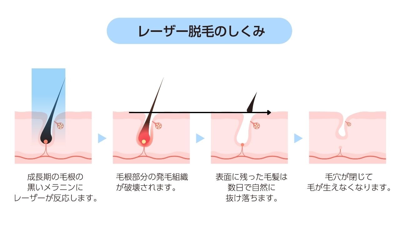 レーザー脱毛の仕組み｜なぜ毛が抜けるのか