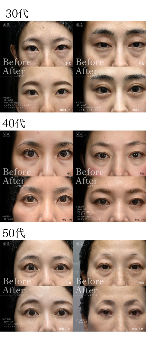 裏ハムラ法の症例を公開