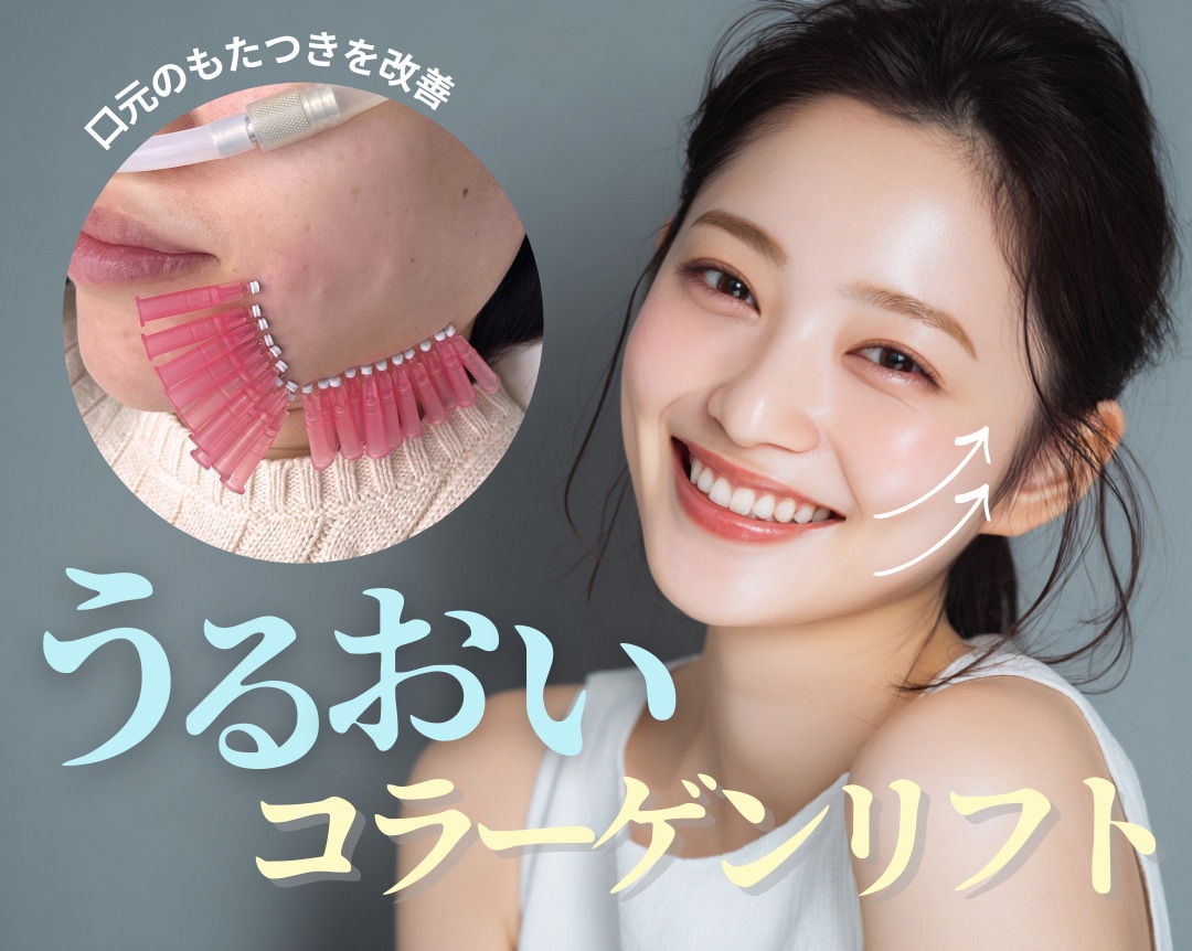 【名古屋栄】韓国でも人気の美容針！”うるおいコラーゲンリフト”たるみ・口元のもたつき改善に