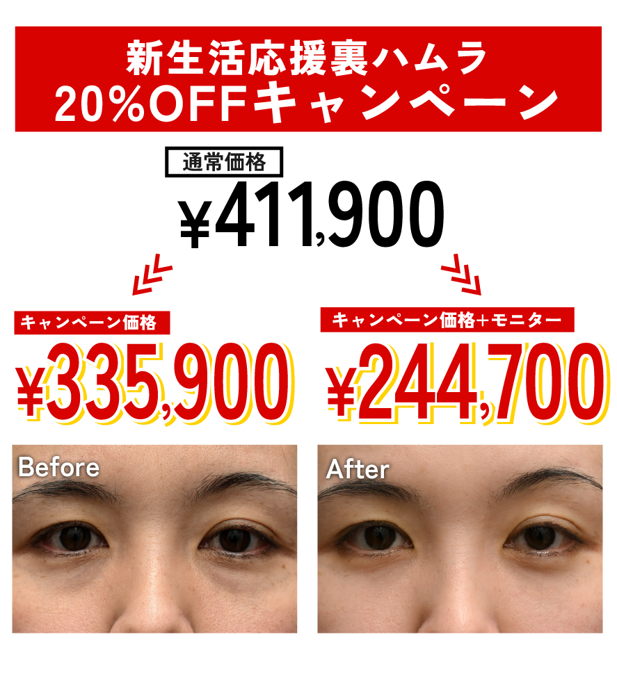 3/31まで限定｜裏ハムラ法が20％OFF